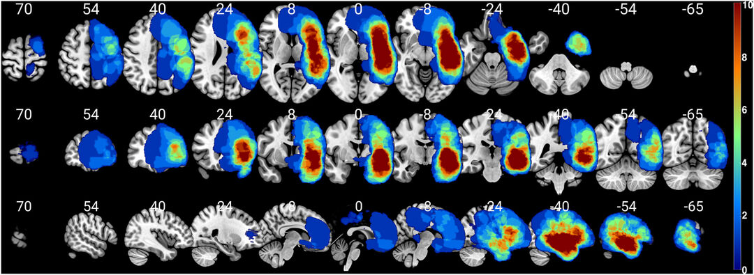 Lesion overlay map of brain tumor patients, Copyright: Lucius Fekonja

