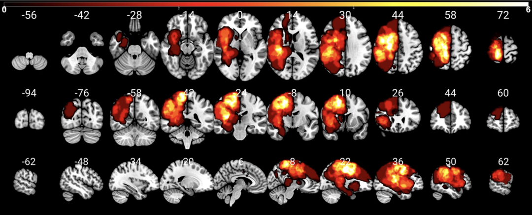 Distribution of the patients’ lesions. Copyright: Lucius Fekonja

