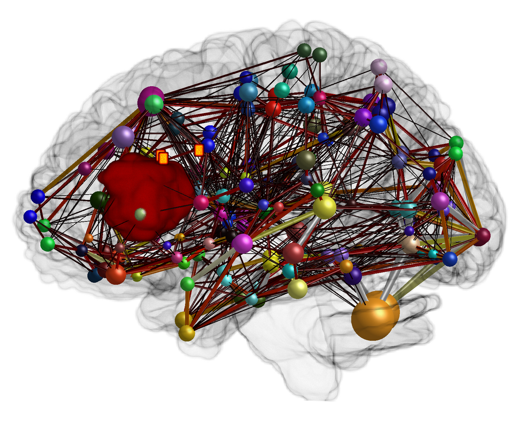 Connectome construction of a patient with a tumor in the speech-eloquent area of the brain.<br />
The connection strengths of the white matter are shown as edges with a heat map (dark = weak connection, light = strong connection). The cortical areas of the brain and their size are illustrated as nodes in the form of spheres. Additionally, three orange TMS points are shown (TMS = Transcranial Magnetic Stimulation). In this case, the patient